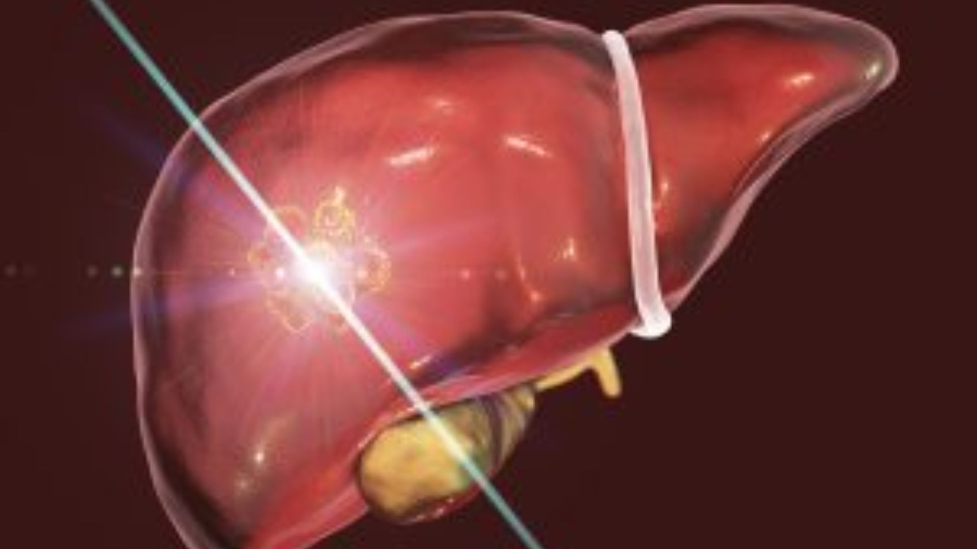 Tratamento para Carcinoma Hepatocelular