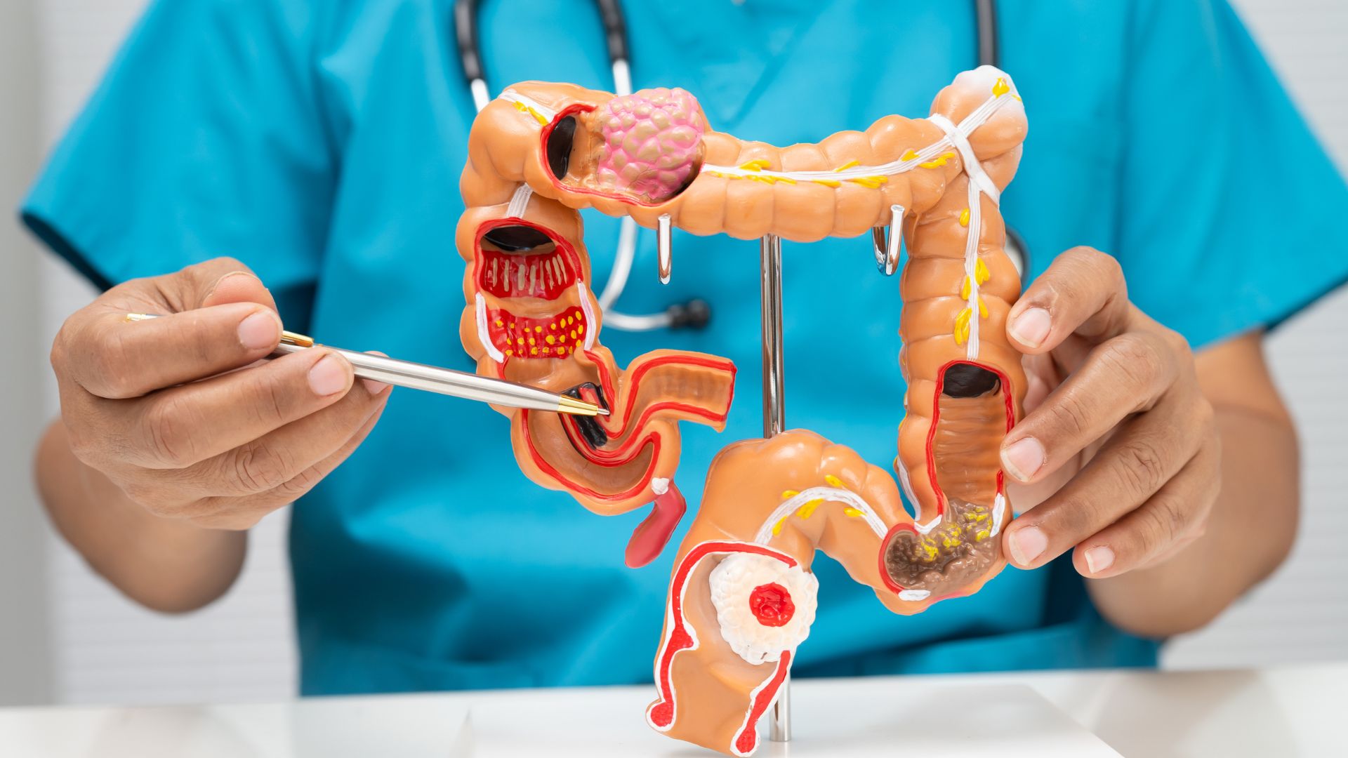 Câncer do intestino delgado: conheça os sintomas, diagnósticos e opções de tratamento disponíveis. Estamos aqui para ajudar!