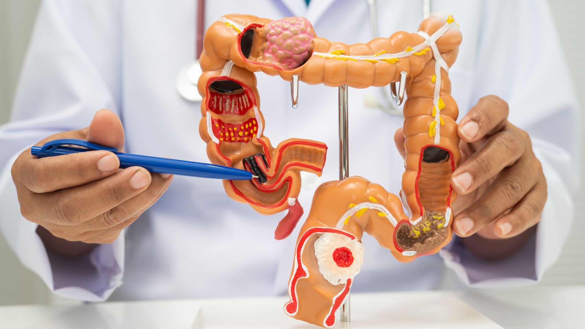 Descubra tudo sobre o câncer de intestino com o Dr Vinícius Simonetti e como o tratamento pode transformar vidas.