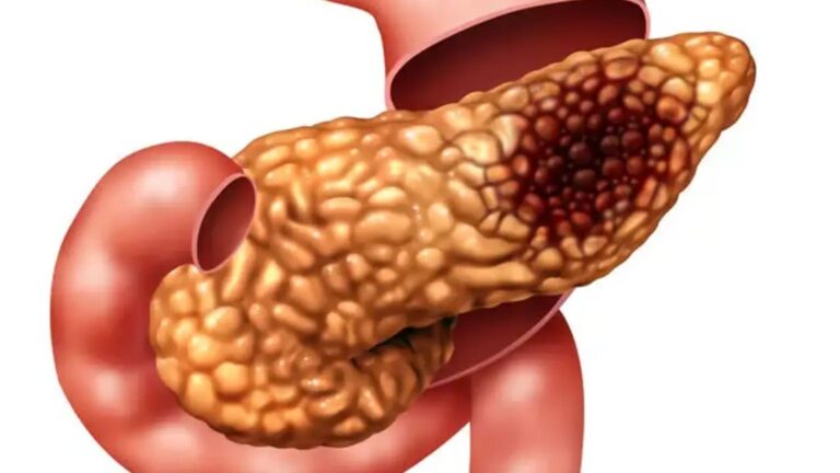 Tratamento para Adenocarcinoma de Pâncreas