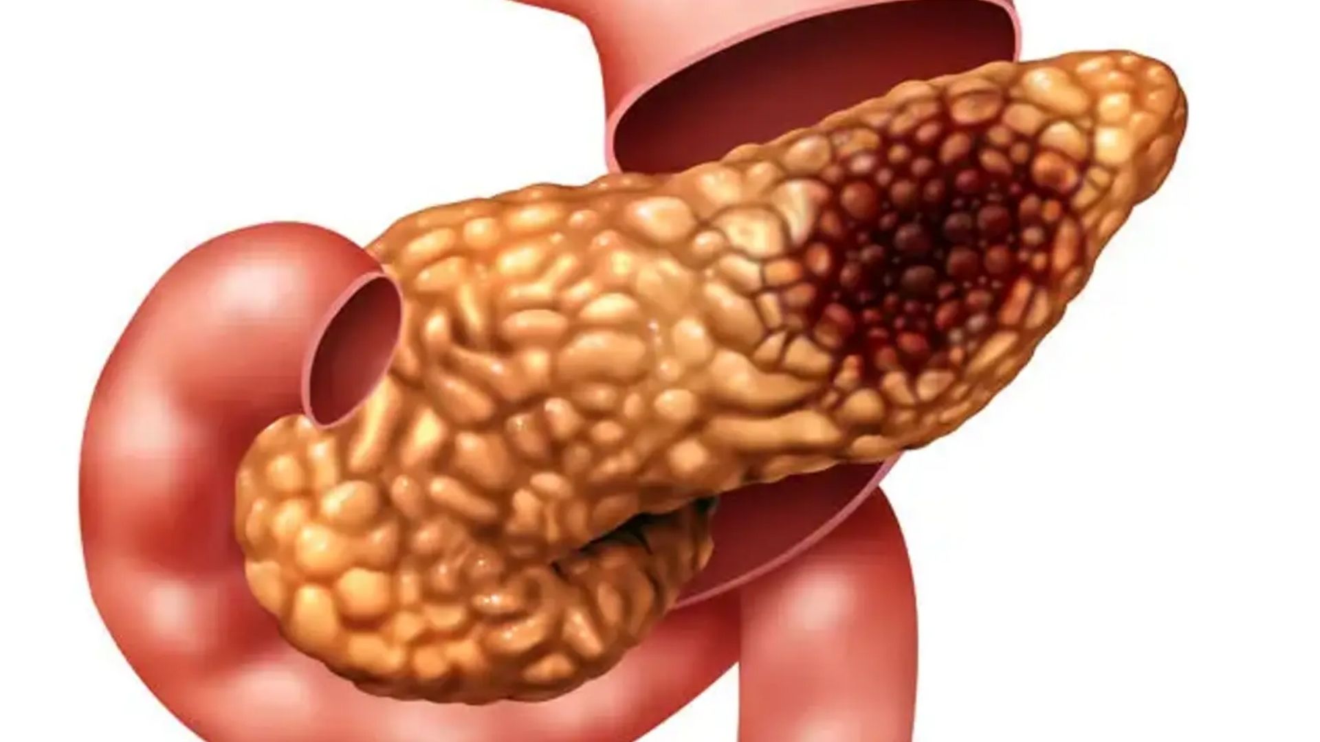 Conheça as opções de tratamento para adenocarcinoma de pâncreas com o Dr Vinícius Simonetti, cirurgião oncológico em São Paulo.