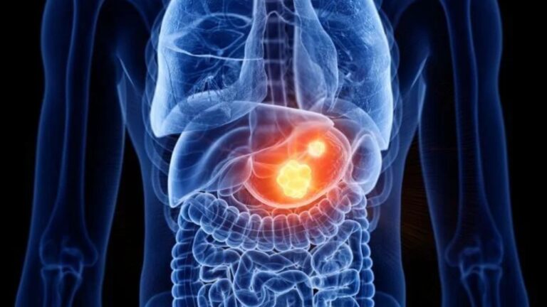 Tratamento para Sarcomas Gastrointestinais