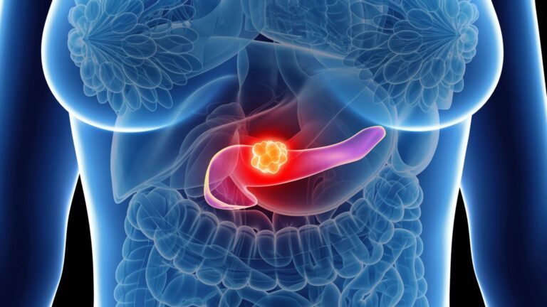 Cirurgia para Adenocarcinoma de Pâncreas