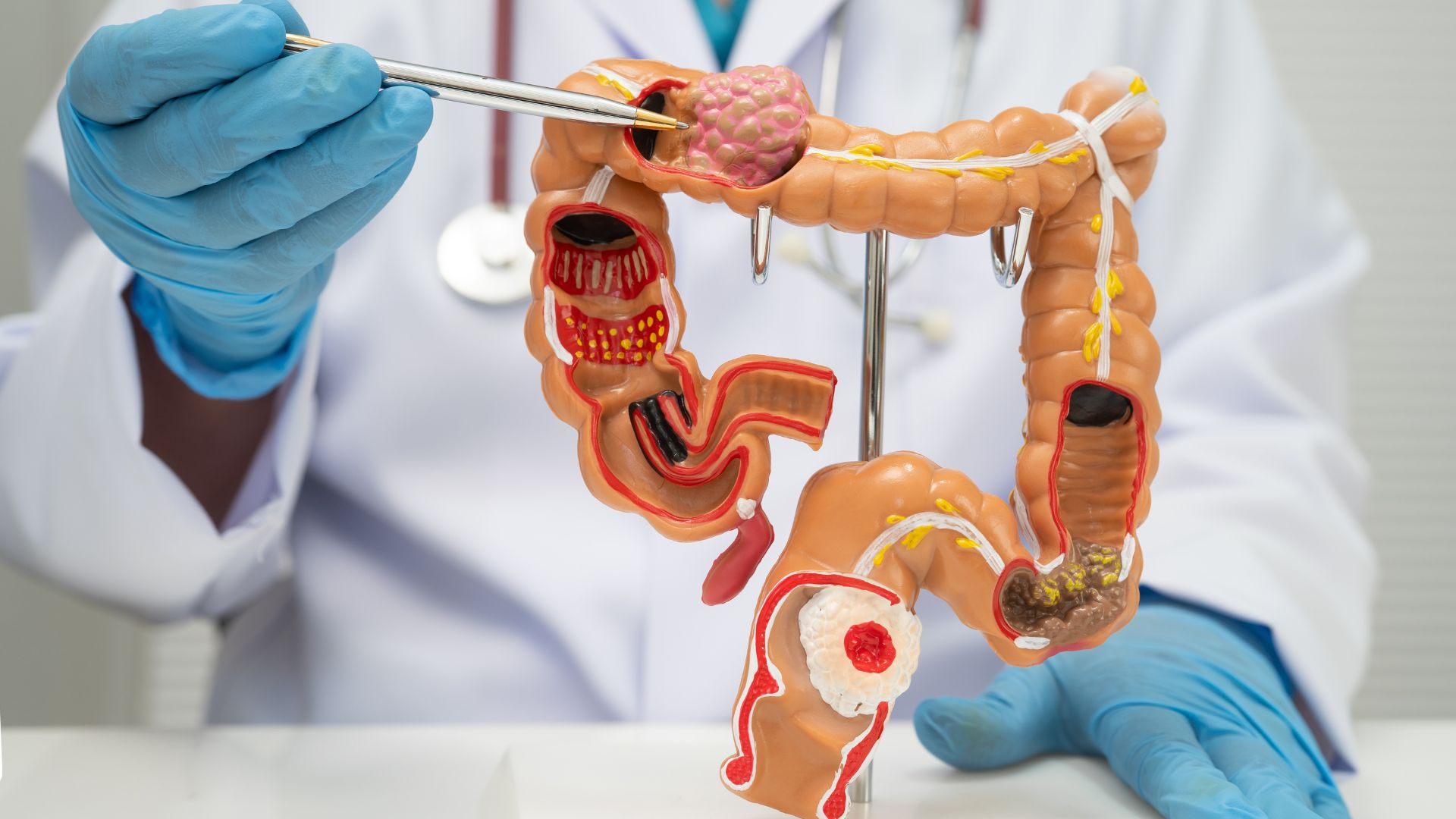 Câncer colorretal: saiba quando a cirurgia é indicada e o que esperar, com o Dr Vinícius Simonetti, cirurgião oncológico.